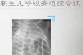 什么是新生兒<em>呼吸</em>窘迫<em>綜合征</em>？